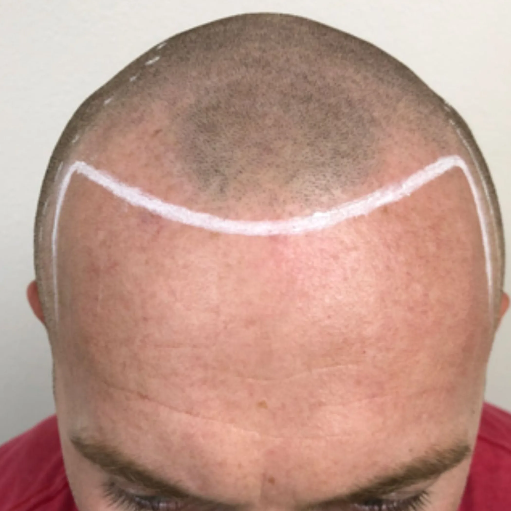 scalp tattoo with natural hairline