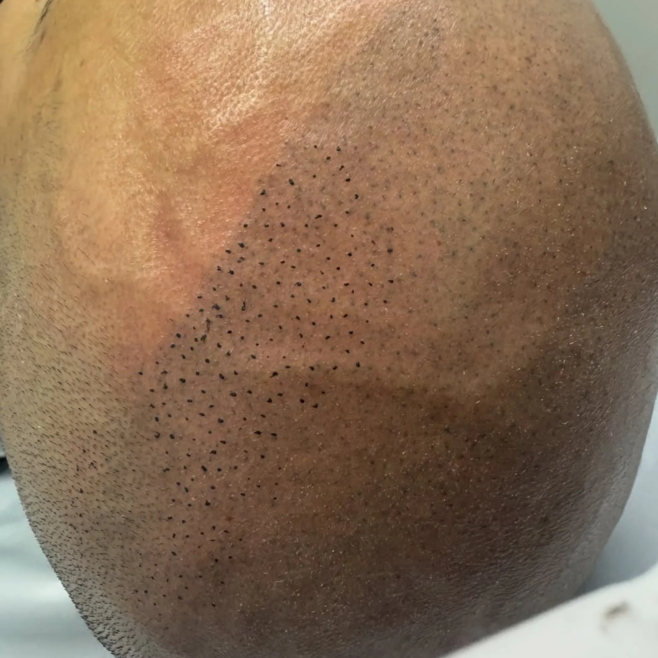 scalp tattoo follicle work